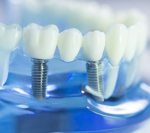 Crystal Lake Dental Implants