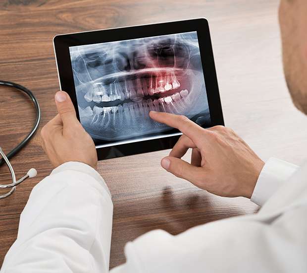 Crystal Lake Types of Dental Root Fractures